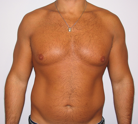 gynecomastia before photo