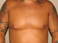gynecomastia after photo