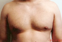 gynecomastia before photo
