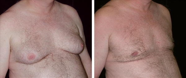 gynecomastia before & after photo