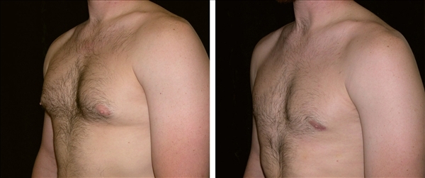 gynecomastia before & after photo