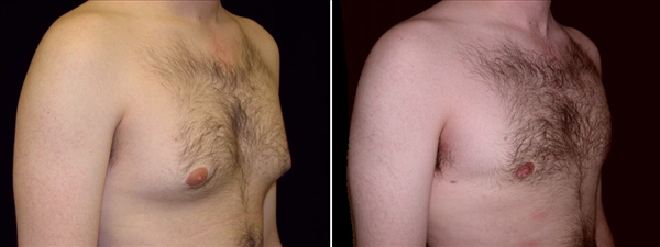 gynecomastia before & after photo