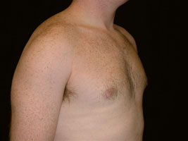 gynecomastia after photo