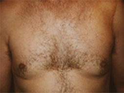 gynecomastia photo