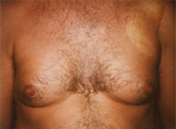 gynecomastia photo
