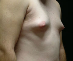 gynecomastia before photo