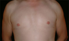 gynecomastia after photo