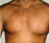 gynecomastia after photo