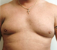 gynecomastia before photo