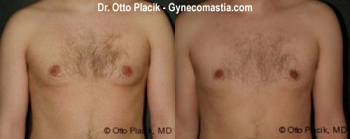 gynecomastia before photo