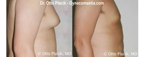 gynecomastia before photo