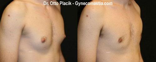 gynecomastia before photo