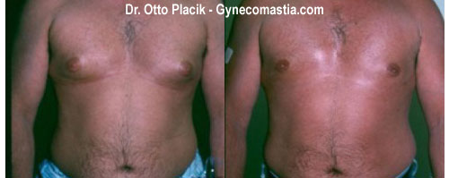 gynecomastia before photo