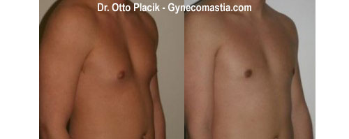 gynecomastia before photo