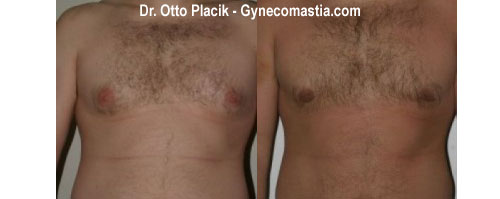 gynecomastia before photo