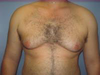 gynecomastia before photo