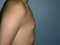 gynecomastia after photo