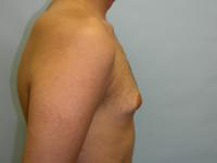 gynecomastia before photo