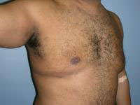 gynecomastia after photo