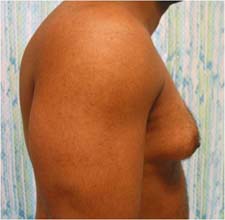 gynecomastia before photo