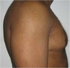 gynecomastia after photo