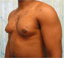 gynecomastia before photo