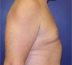 gynecomastia after photo