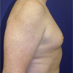 gynecomastia before photo