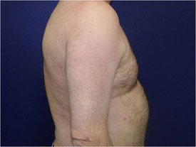 gynecomastia after photo