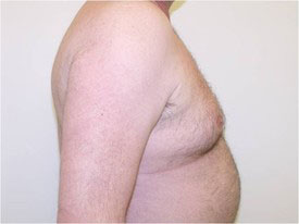 gynecomastia before photo