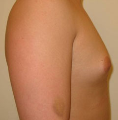 gynecomastia before photo