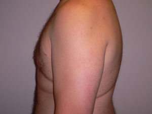 gynecomastia after photo