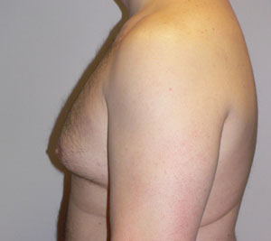 gynecomastia before photo