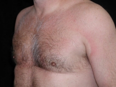 gynecomastia after photo