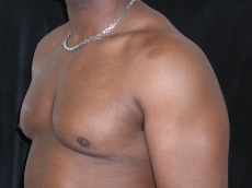 gynecomastia after photo