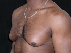 gynecomastia before photo