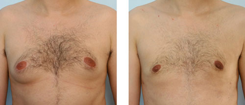 gynecomastia before photo