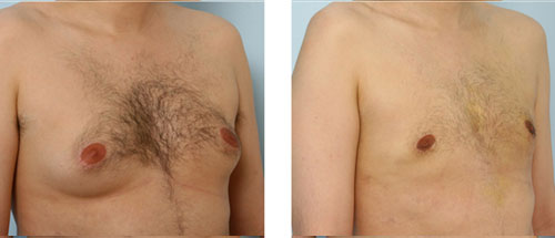 gynecomastia before photo