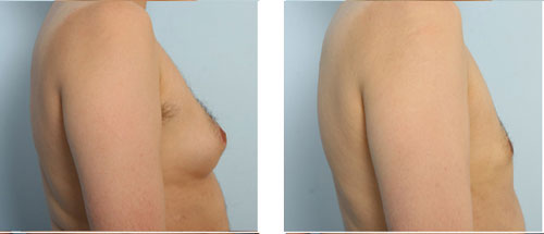 gynecomastia before photo