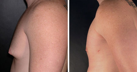 Raloxifene Gynecomastia Before After