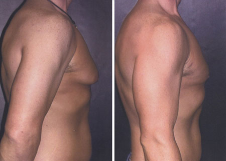 before and after male breast reduction